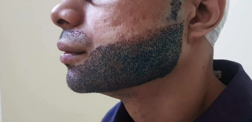 Side view of lower half face with beard transplants Stock Photos