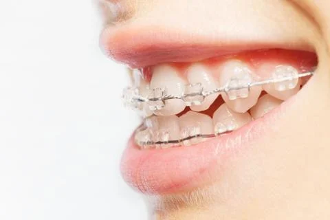 Side view picture of teeth with clear braces Stock Photos