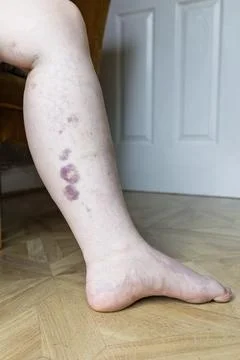Side View of Womans Bruised Lower Leg While Seated Stock Photos