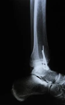 Side view of X-RAY scan. Human leg with metal screw after the surgery. Stock Photos
