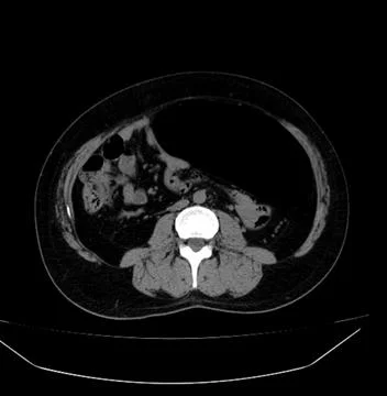 Sigmoid Volvulus CT Scan Examination  1 Stock Photos