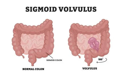 Sigmoid Volvulus vs Normal Colon Medical Diagram, educational medical poste.. Illustrazione stock
