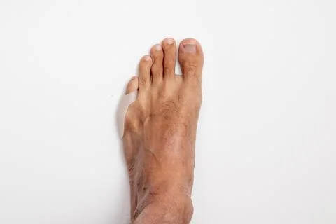 Silicone spacer, separator or protector for the condition tailors bunion or 库存照片