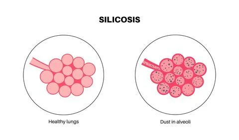 Silicosis dust in lung Stock Illustration