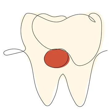 Simple Illustration of a Tooth With a Colored Cavity Highlighting Dental Decay Stock Illustration