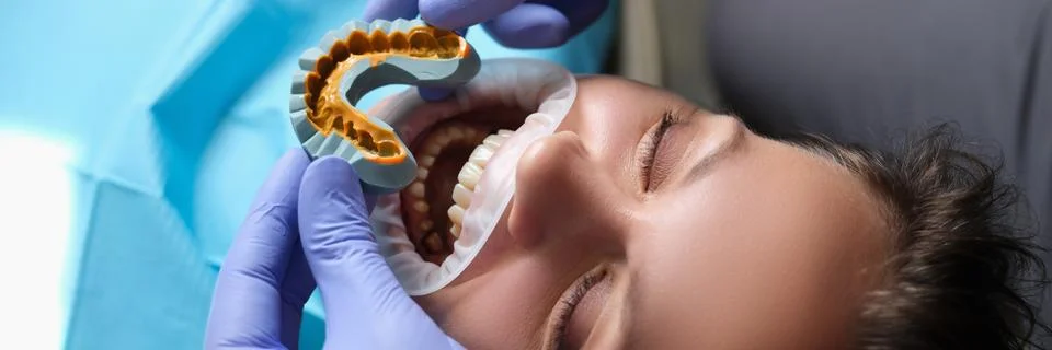 Simulation of artificial teeth on plaster model and patient with open mouth at Stock Photos