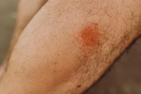 Simuliidae black fly bite mark on the leg below the knee Foto stock