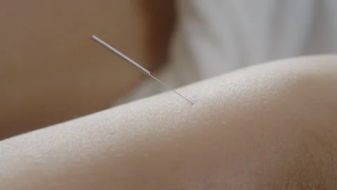 Single Acupuncture Needle In Skin Stock Footage 275047497