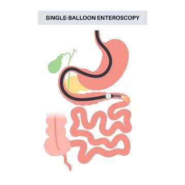 Single balloon enteroscopy Stock Illustration