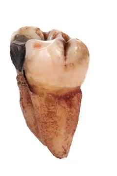 Single extracted molar tooth with caries decay and filling isolated on white  Stock Photos