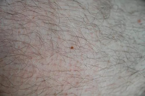 Single Freckle Stock Photos