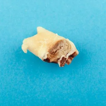 Single highly decayed wisdom tooth on a blue background Stock Photos