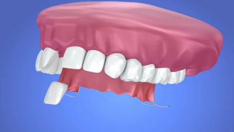 Single Missing Tooth - Removable partial denture. 3d animation Stock Footage 89565833