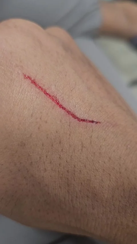A single, shallow linear scratch with a small amount of dried blood on human Stock Footage 338308277
