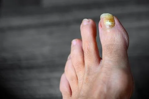Single toe shows thickened, discolored nail Stock Photos