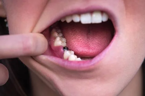 Single tooth implant. Missing tooth. Implant after tooth extraction Stock Photos
