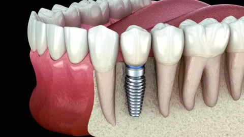 Single Tooth Implant Placement Animation in Lower Jaw Stock Footage 327666873