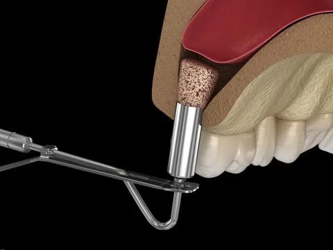 Sinus Lift Surgery - Adding new bone. 3D illustration Stock Illustration