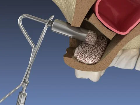 Sinus Lift Surgery - Adding new bone. 3D illustration Stock Illustration