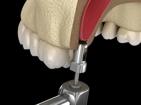 Sinus Lift Surgery - Creating an access to the Sinus. 3D illustration Stock Illustration