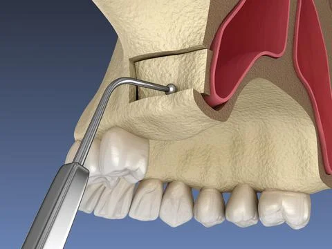 Sinus Lift Surgery - Creating side access to the Sinus. 3D illustration Stock Illustration