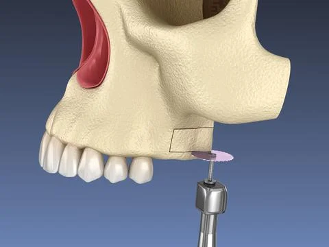 Sinus Lift Surgery - Creating side access to the Sinus. 3D illustration Stock Illustration