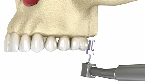 Sinus Lift Surgery with frontal access. 3D animation of dental surgery Video stock 129321878