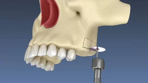 Sinus Lift Surgery with lateral access. ... | Stock Video | Pond5