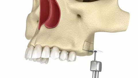 Sinus Lift Surgery with lateral access. 3D animation of dental surgery Stock Footage