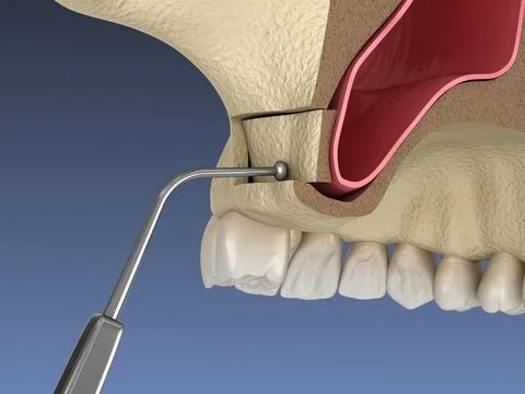 Sinus Lift Surgery - Moving sinus membrane. 3D illustration Stock Illustration