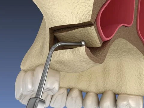 Sinus Lift Surgery - Moving sinus membrane. 3D illustration Stock Illustration