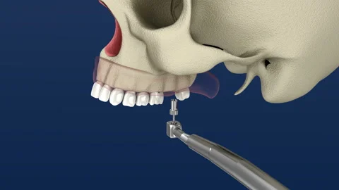 Sinus Lift Surgery - Sinus Augmentation. 3D Animation. Video stock 89582327