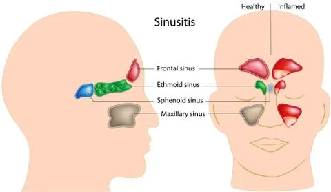 Sinusitis Stockillustratie