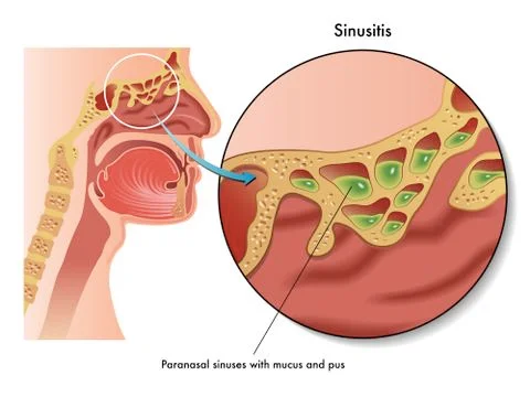 Sinusitis Stock Illustration
