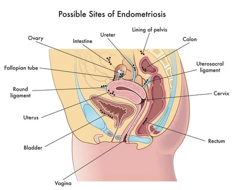 Sites of Endometriosis Stock Illustration