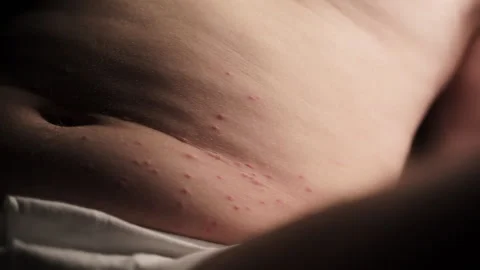 Sites of insect bites that have triggered an allergic response On the Video stock 244453124