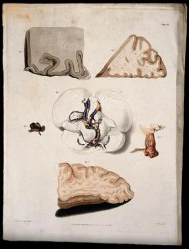 Six sections of diseased brain. Coloured stipple etching by W. T. Fry after.. Stock Illustration