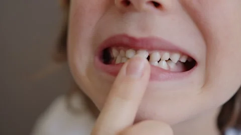 Six-year-old boy explores his changing mouth. He uses a finger to check his 스톡 동영상 337643313