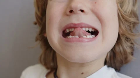 Six year old boy shows his wobbly upper baby incisor and changing teeth with 스톡 동영상 337642843