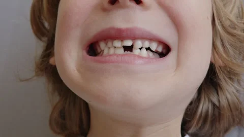 A six-year-old boy smiles, showing a slit with his tongue through which the 스톡 동영상 337643432