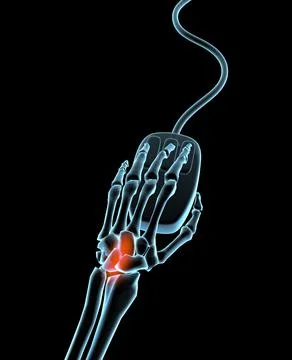 Skeleton of the human hand using a computer mouse showing carpal tunnel syndrome 스톡 일러스트