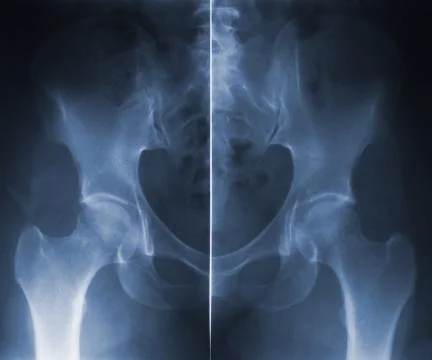 Skiagram hip backbone Stock Photos