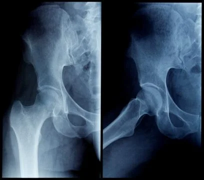 Skiagram human hip Stock Photos