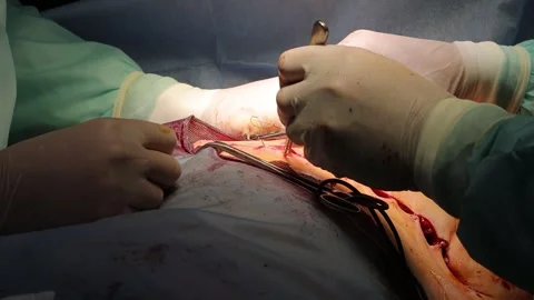 Skilled surgeon and assistant suturing during surgery Stock Footage 247029138
