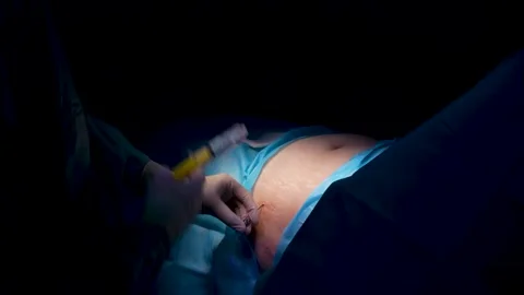 Skilled surgeon in a dark operating room carefully performing a liposuction Stock-Footage 345682267