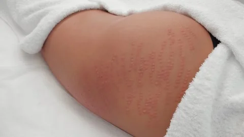 Skin after procedure Stock Footage 287958991