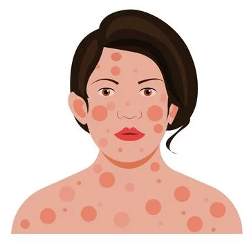 Skin Allergy Stock Illustration