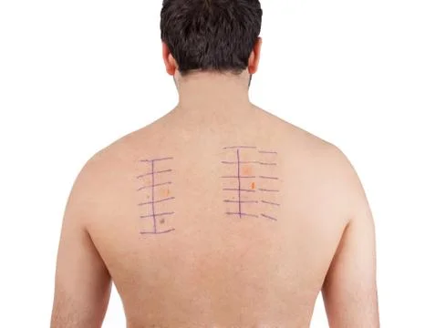 Skin Allergy Patch Test on Bacck Stock Photos