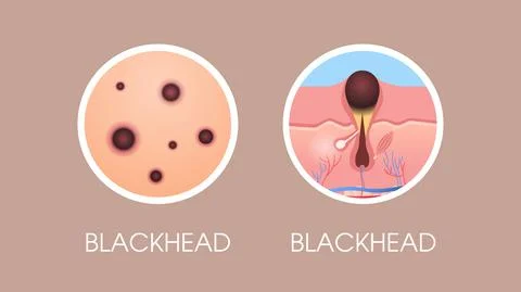 Skin blackhead pimples acne type face pore comedones cosmetology skincare Stock Illustration
