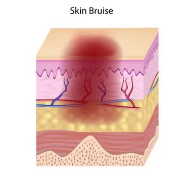 Skin bruise Stock-Illustration